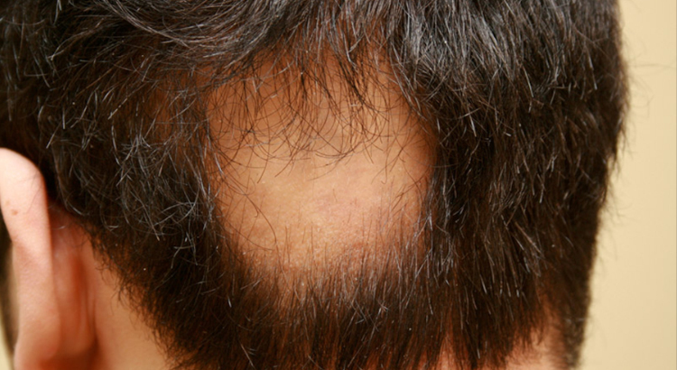 alopecia tipo areata